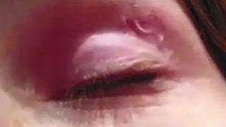 Şaşkına çeviren vaka! Alman kadının gözünden solucan çıkarıldı