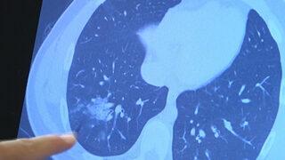 Aşı olmayan çocuklar için büyük tehlike! Akciğerler etkileniyor