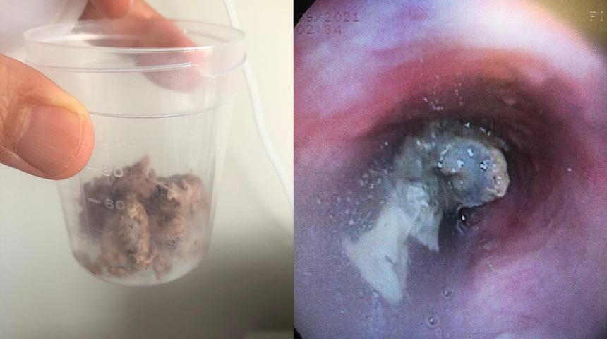 Yemek borusundan 6 santimetrelik et parçası çıktı