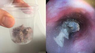 Yemek borusundan 6 santimetrelik et parçası çıktı