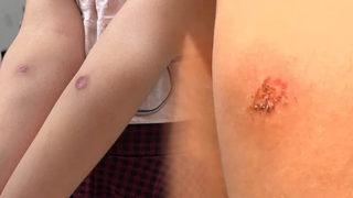 İstanbul'da Asya kaplan sivrisineği tehlikesi! Isırığında 3 ölümcül hastalık riski var