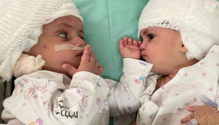 İsrail'de dünyaya gelen yapışık ikizler ameliyatla ayrıldı! Birbirlerine ilk kez baktılar