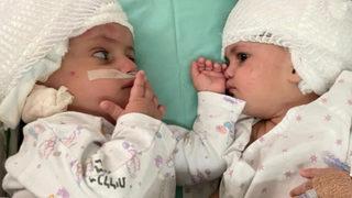 İsrail'de dünyaya gelen yapışık ikizler ameliyatla ayrıldı! Birbirlerine ilk kez baktılar