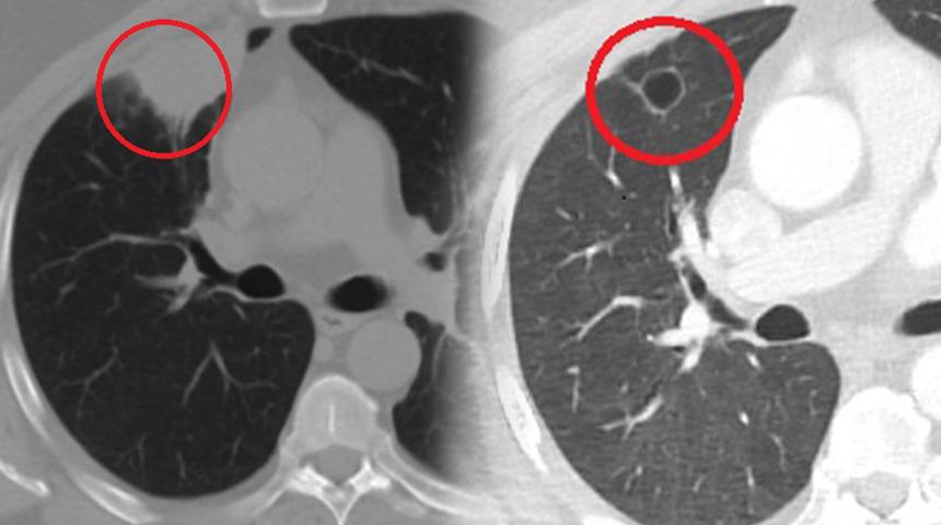 Dünya tıp literatüründe bir ilk! Koronavirüs akciğer kanserini taklit etti