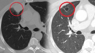 Dünya tıp literatüründe bir ilk! Koronavirüs akciğer kanserini taklit etti