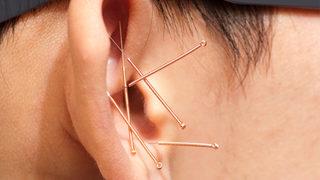 Akupunkturla zayıflama