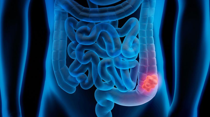 Kalın bağırsak kanserinde yeni umut