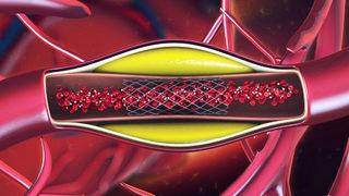 Atardamar balonlaşmasına dikkat!