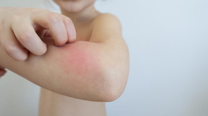 Alerjik deri testleri nasıl yapılır?