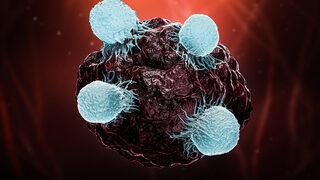 Lenfoma belirtileri ve tedavisi nedir? Ağrısız şişliklere dikkat!