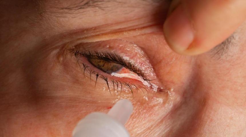 Göz nezlesine dikkat