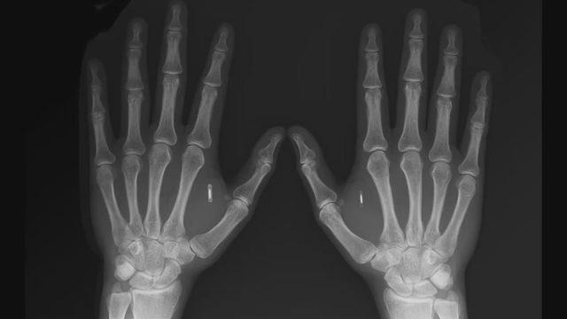 Türk Iron Man Tolga Özuygur, derisinin altına çip yerleştirdi