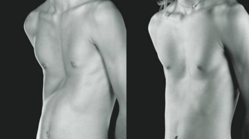 Kunduracı göğsü nedir?