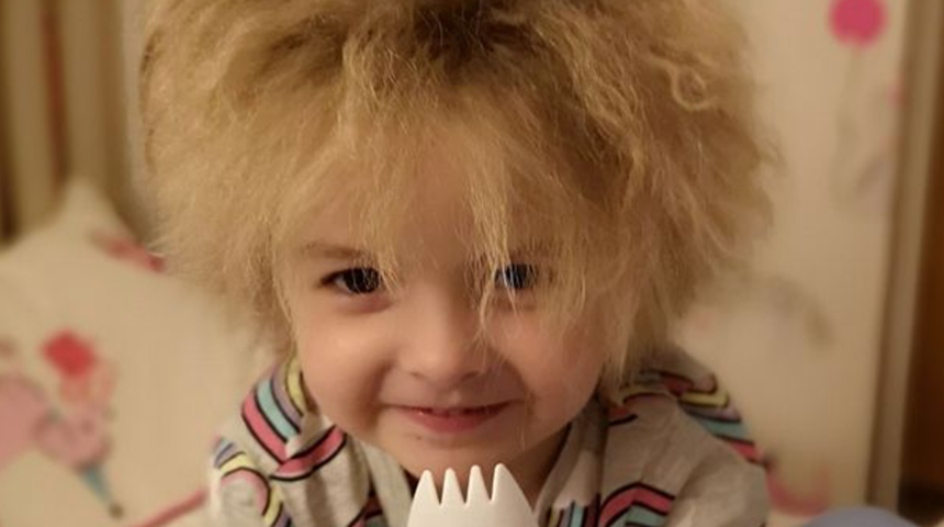 Albert Einstein da aynı hastalığı yaşıyordu! Saçları milyonda bir görülüyor, sosyal medya onu konuşuyor