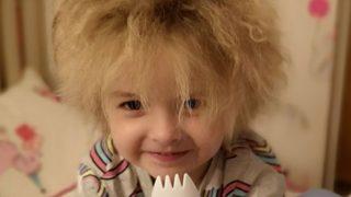 Albert Einstein da aynı hastalığı yaşıyordu! Saçları milyonda bir görülüyor, sosyal medya onu konuşuyor