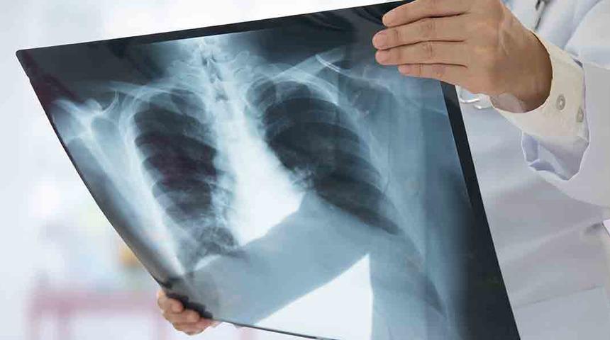 Sigara 'kronik bronşit' nedeni