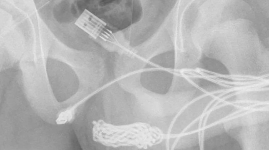 Akılalmaz olay! Merakı başına dert oldu, İngiliz gencin penisinden USB kablosu çıkarıldı