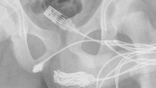 Akılalmaz olay! Merakı başına dert oldu, İngiliz gencin penisinden USB kablosu çıkarıldı