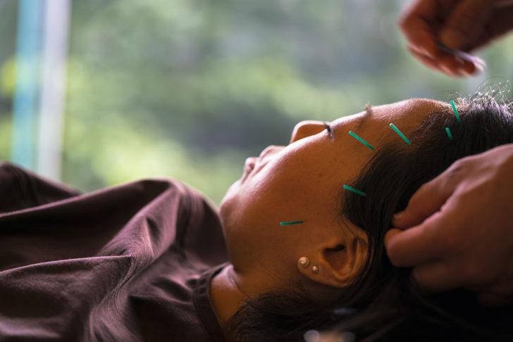 Migren ve akupunktur tedavisi