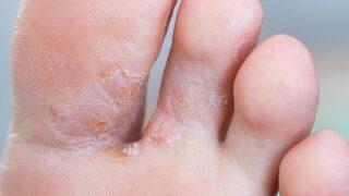 Ayak mantarına dikkat