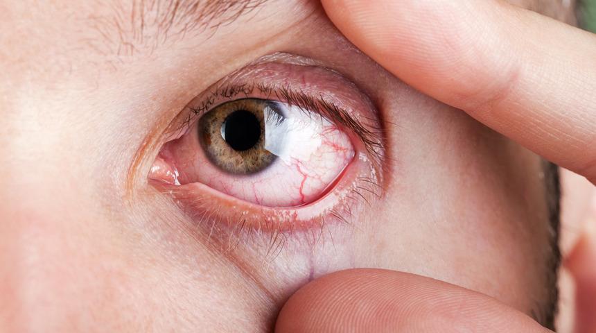 Normal tansiyonlu glokom nedir?