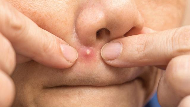 Yüzdeki 'ölüm üçgeni'ne dikkat! Çinli adamın beyni iltihapla doldu