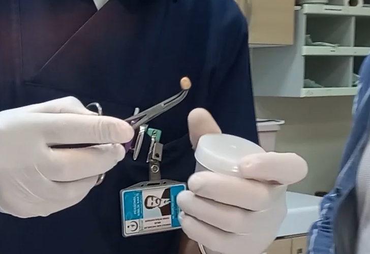 Akıllara durgunluk veren kopya düzeneği! Kulağından hastanede çıkartılabildi G4