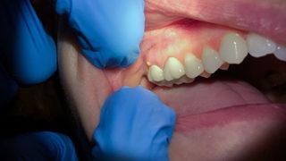 Dişeti hastalığı kalp krizine yol açıyor