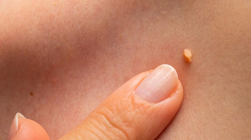 Vücudunuzda çıkan siğilleri önemseyin