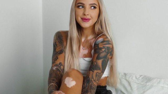 Vitiligo hastalığı nedeniyle uzun yıllar dışlandı! Şimdi ise herkes onun peşinde