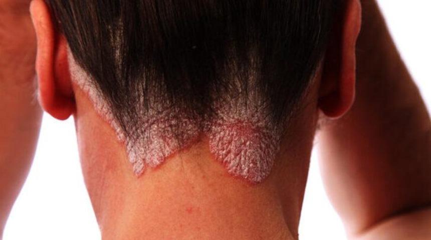 Duygusal sıkıntı egzama sebebi