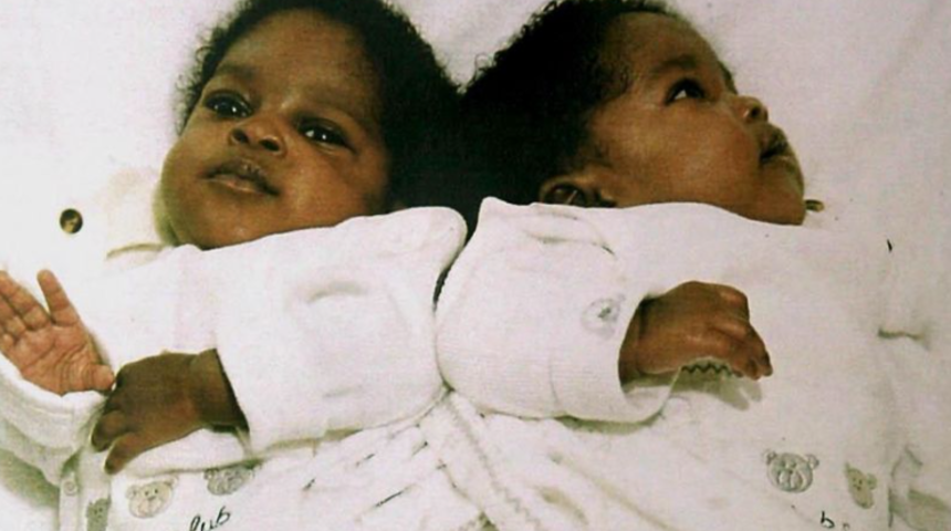Yapışık ikiz olarak doğan kardeşler, 20 yıl önce ayrıldı! Hala bağlı uyuyorlar