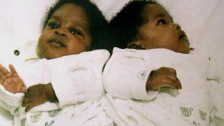 Yapışık ikiz olarak doğan kardeşler, 20 yıl önce ayrıldı! Hala bağlı uyuyorlar