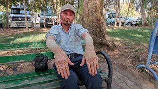 Hastalığı hayatını kâbusa çevirdi! İnsanlar kendisinden kaçıyor