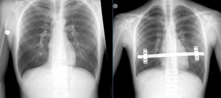 Trabzon'da, "kapalı kunduracı göğsü ameliyatı" olan hasta sağlığına kavuştu G2