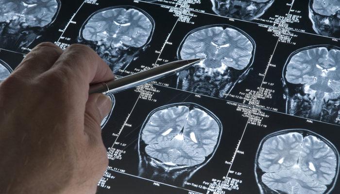 Erken yaşta önlem alın! 2050 yılında milyonlarca kişi Alzheimer'dan etkilenecek