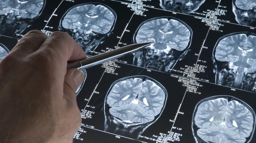 Erken yaşta önlem alın! 2050 yılında milyonlarca kişi Alzheimer'dan etkilenecek