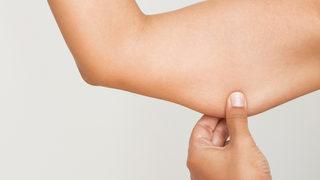  Belt lipektomi nedir?  Belt lipektomi ameliyatı ve faydaları