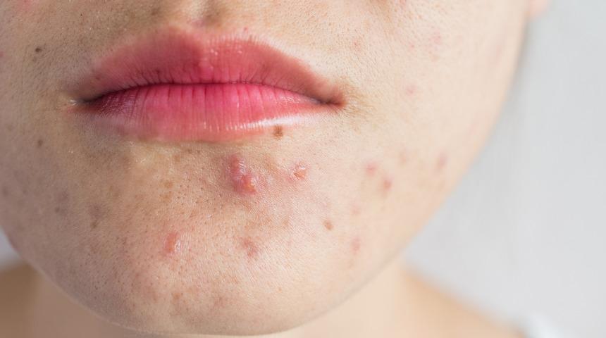 Sivilceye iyi gelen besinler nelerdir? Bunlardan uzak durun