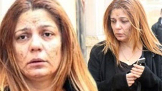 Şarkıcı İzel’in yüzündeki izler nasıl oldu? İzel'in yüzüne ne oldu?