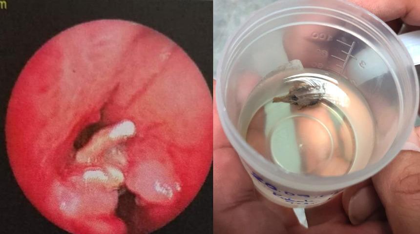 Geçmeyen nefes darlığı ve öksürük şikayeti yaşıyordu! Akciğerinden çıkan şoke etti