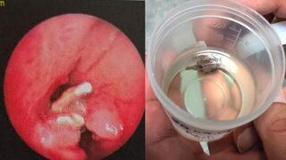 Geçmeyen nefes darlığı ve öksürük şikayeti yaşıyordu! Akciğerinden çıkan şoke etti