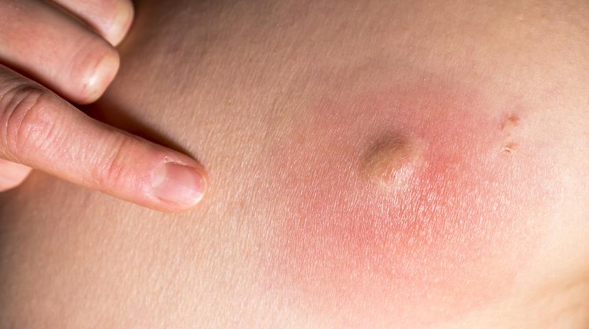 Milas'ta "şark çıbanı" tehlikesi      