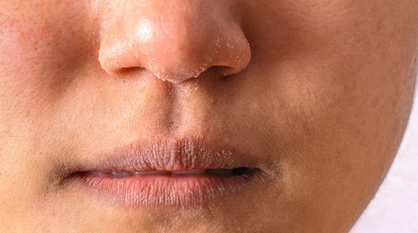 Kuru ciltlerin &ccedil;ilesi bitiyor! Bu ev yapımı maske &ouml;nerileri sayesinde...