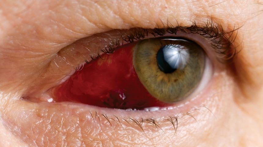 Göz tansiyonu (glokom) tedavisinde erken tanı hayat kurtarıyor!