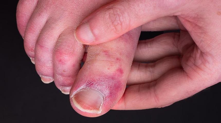 Covid: Bazı hastaların el ve ayak parmakları neden morarıyor?