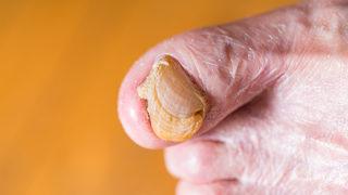 Tırnak tümörü nedir, belirtileri ve tedavisi nasıl olur? Tırnak mantarıyla karıştırmayın