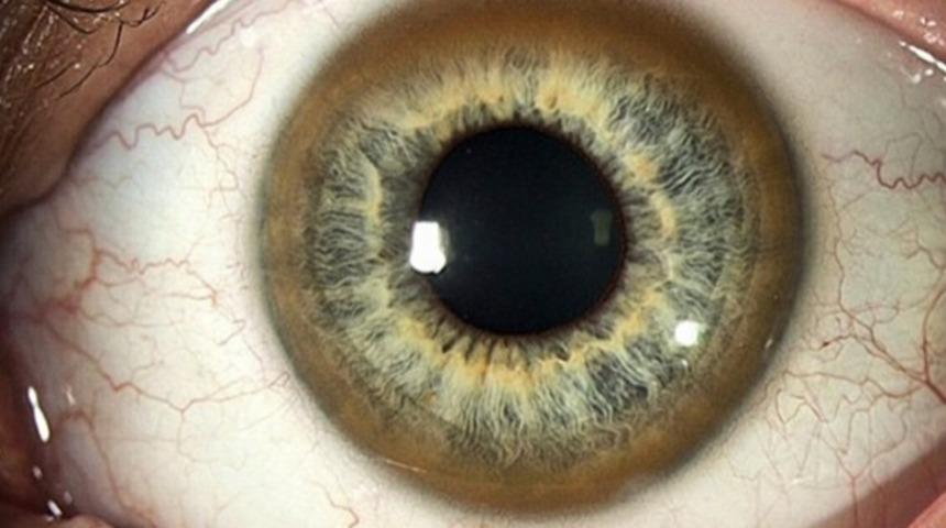 Akraba evliliği Wilson hastalığına neden oluyor 