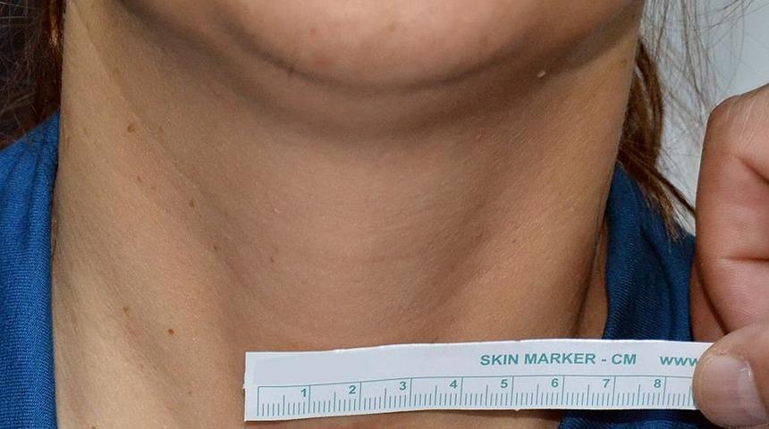 Tiroid hastalıkları kalbi bozuyor