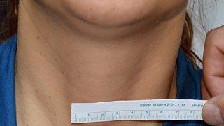 Tiroid hastalıkları kalbi bozuyor